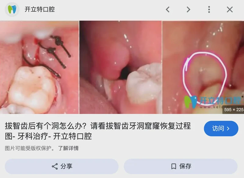 拔牙那天，我像个被剥了皮的苹果！